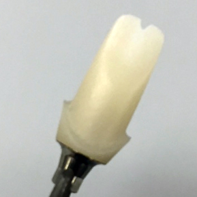 Custom hybrid abutment on Open Implants ti-base